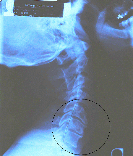 Bone Spur Neck