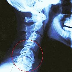 How I Dealt with a Massive Pain the Neck